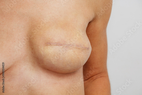 Photos Post-mastectomy breast with reconstruction and surgical scars