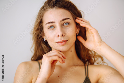 Beautiful young girl with problem skin. Young woman with wavy hair gently touching her face. Dermatology, cosmetology, skin care. Natural skin.