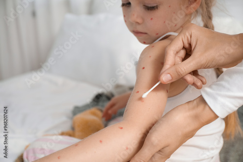 Mother smearing her little daughter ill with chickenpox in bedroom, closeup photo