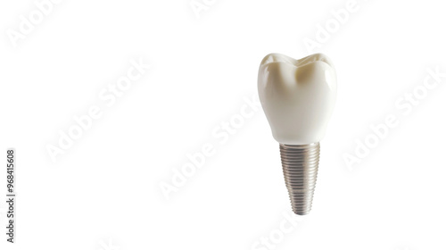 Dental implant model of molar tooth on transparent background