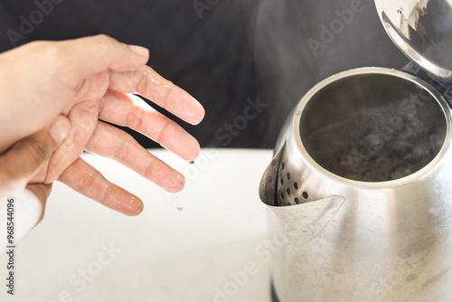 Woman’s hands with burning pain from scalding heat water,boiling water and hot steam in the electric kettle spilled onto skin of her hand,girl suffering harm and injury,scald blister,accident at home