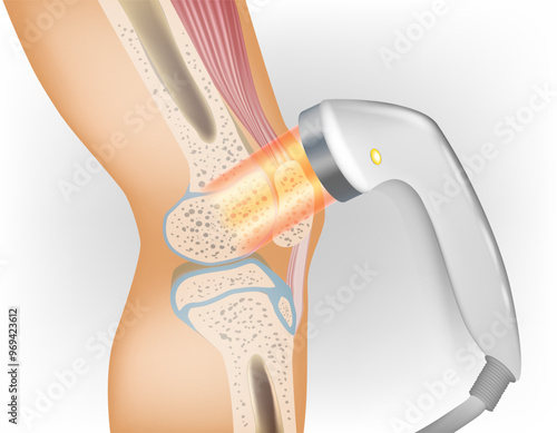 Laser therapy on a knee. Medical Laser Therapy Science