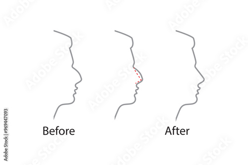 Rhinoplasty nose plastic surgey icon. Vector rhinoplasty beauty icon.
