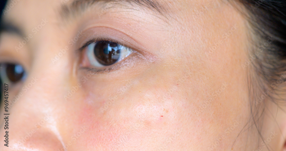 Obraz premium Swelling from needle after cosmetic procedures, reducing wrinkles under eyes. Beauty medical procedure.