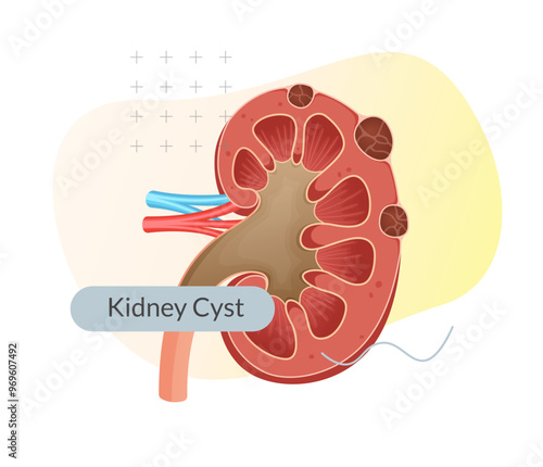 Kidney Cysts - Round Pouches of Fluid on Kidney - Stock Illustration