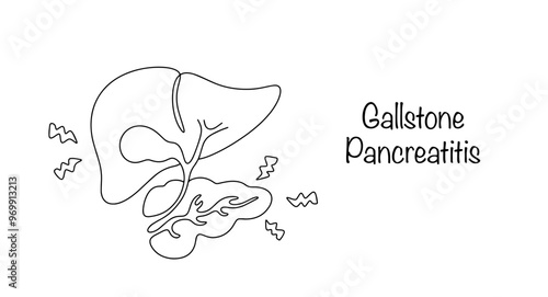 Gallstone Pancreatitis