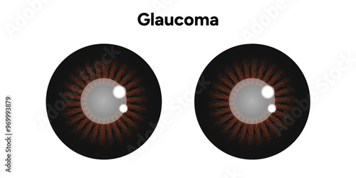 Eye structure defect eye Glaucoma