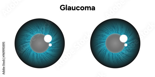 Eye structure defect eye Glaucoma