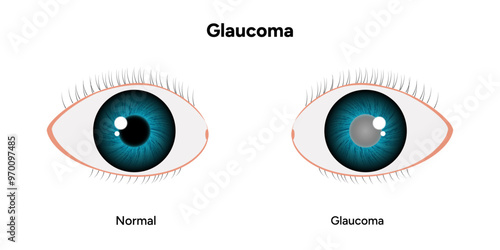 Eye structure defect eye Glaucoma