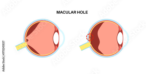 Macular hole disease