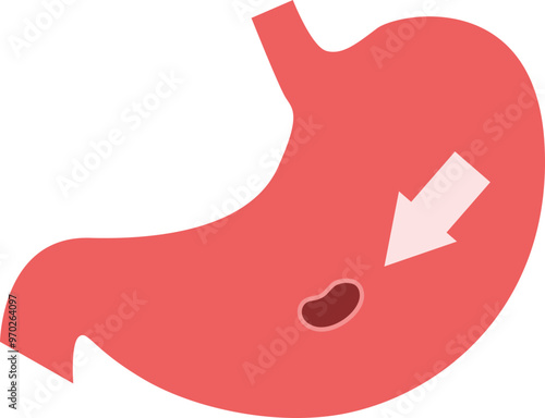 Gastric Ulcer