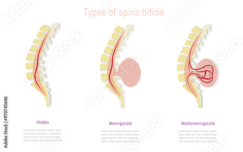 Medical illustration depicting types of spina bifida: hidden, meningocele, and myelomeningocele with detailed spinal anatomy.
