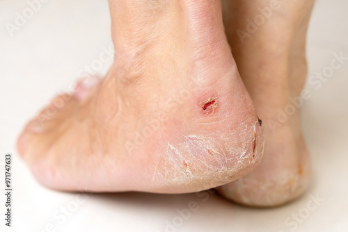 Female feet with cracked heels close up