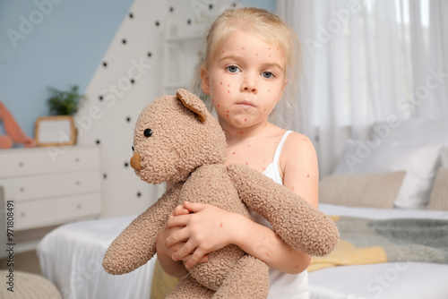 Little girl ill with chicke...
