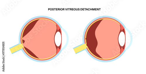 Posterior vitreous detachment