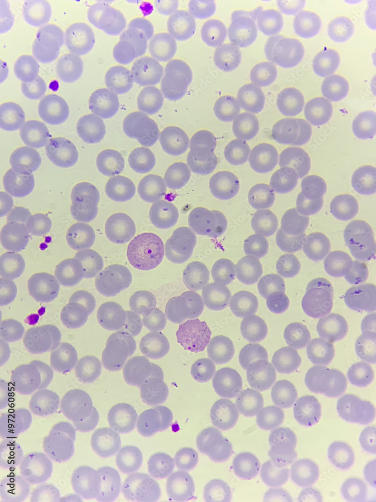 A smear of human blood under a microscope. Blood cells, red blood cells, white blood cells. A smear of human blood under a microscope. Blood cells, red blood cells, white blood cells.