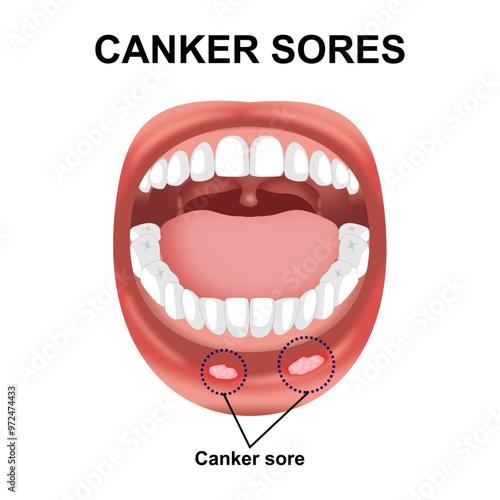 Canker sores mouth illustration