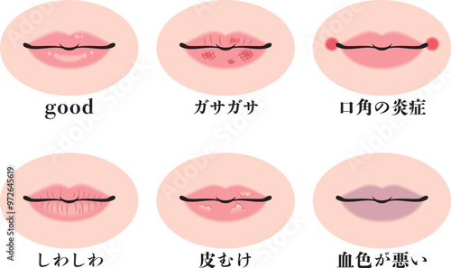 トラブルのある唇セット