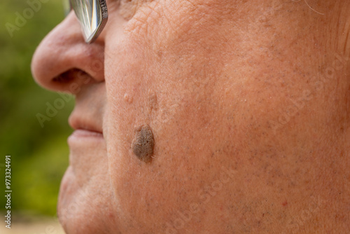 Tableau sur toile Close-Up of Brown Seborrheic Keratosis (Seborrhoeic wart, Basal cell papilloma,