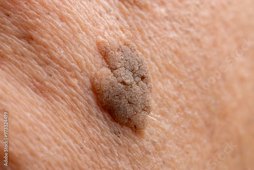 Photos Close-Up of Brown Seborrheic Keratosis (Seborrhoeic wart, Basal cell papilloma,