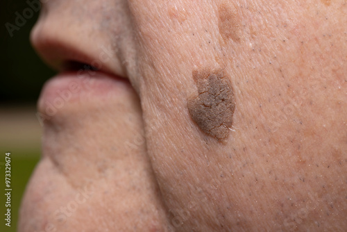 Foto Close-Up of Brown Seborrheic Keratosis (Seborrhoeic wart, Basal cell papilloma,