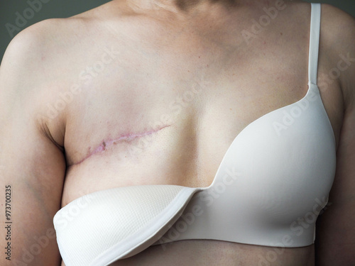 Scar from Total Mastectomy operation - unrecognized woman fight with her breast cancer, one of the breast cancer treatment
