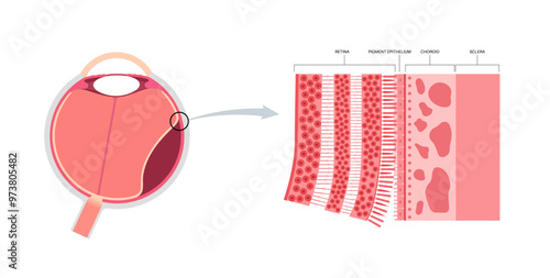 Retinal detachment eye disease