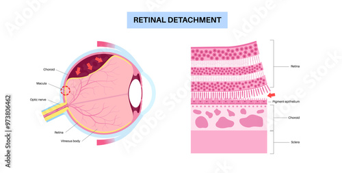 Retinal detachment eye disease