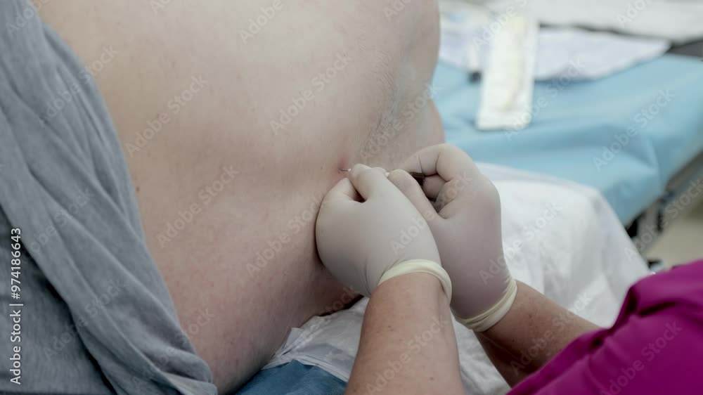 Injection of spinal anesthesia being administered as part of the ...