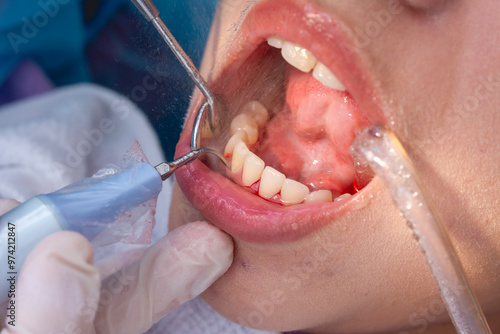 Tableau sur toile An oral prophylaxis procedure