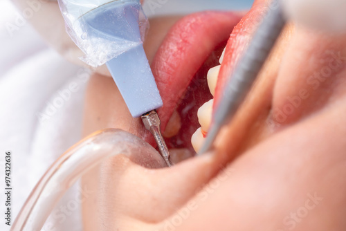 Closeup of an oral prophylaxis or dental cleaning procedure. A dental scaler is being used to remove plaque or tartar from the teeth, while a saliva ejector keeps the area dry. photo