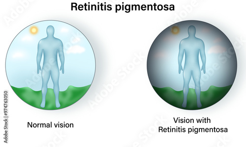 Comparative Analysis of Vision: Science Vector Illustration Showcasing Normal Vision and the Effects of Retinitis Pigmentosa on Eye Function and Visual Perception
