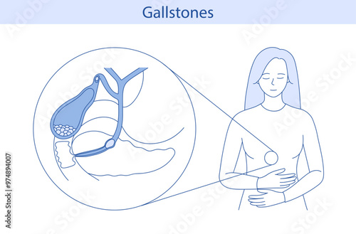 Schematic vector illustration of the structure of the gallbladder with stones.