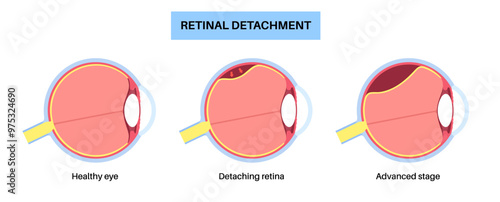 Retinal detachment eye disease