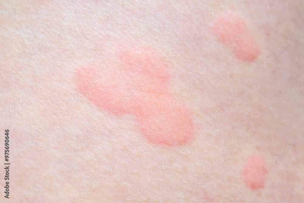 Skin allergy rash dermatitis texture close up background Skin allergy rash dermatitis texture close up background