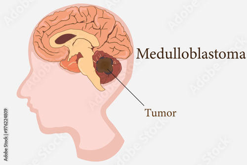 medulloblastoma, human head and brain cross section side view. eps 10