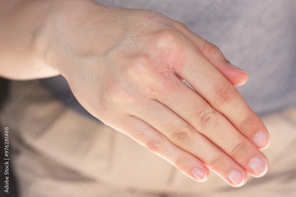 Close-up of a woman’s hands with eczema flare-up.