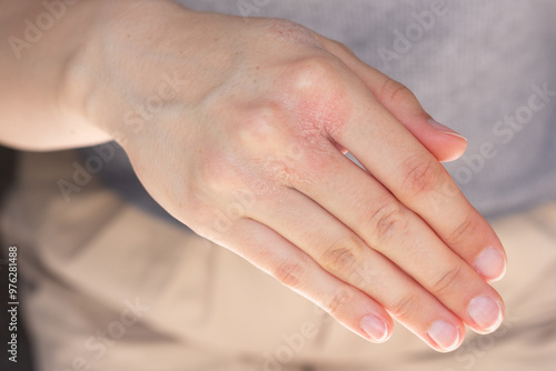 Obraz na płótnie Close-up of a woman’s hands with eczema flare-up. w salonie