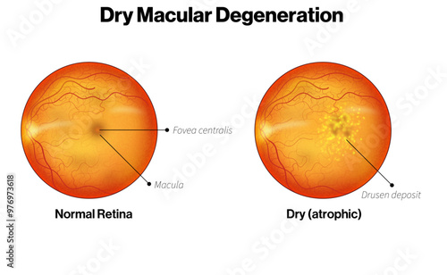 Dry Macular Degeneration vs Normal Retina Scientific Illustration, Comparison Visualization