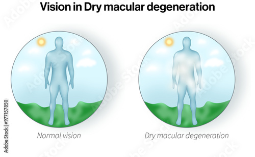 Comparing Vision in Normal and Dry Macular Degeneration: Detailed Science Vector Illustration of Age-Related Eye Conditions and Their Effects on Central Vision