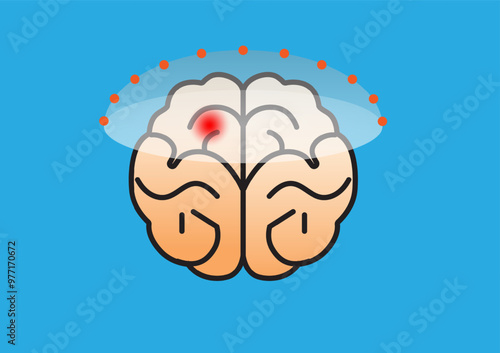 Illustration of focused ultrasound treatment targeting a specific region of the brain, representing a non-invasive therapy for neurological diseases.