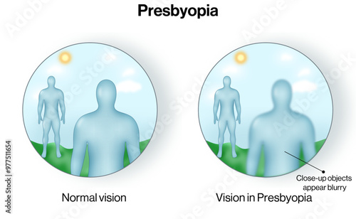 Comparative Illustration of Vision in Normal and Presbyopia Eye Conditions: A Science Vector Guide to Aging Vision and Visual Clarity