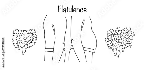 Flatulence