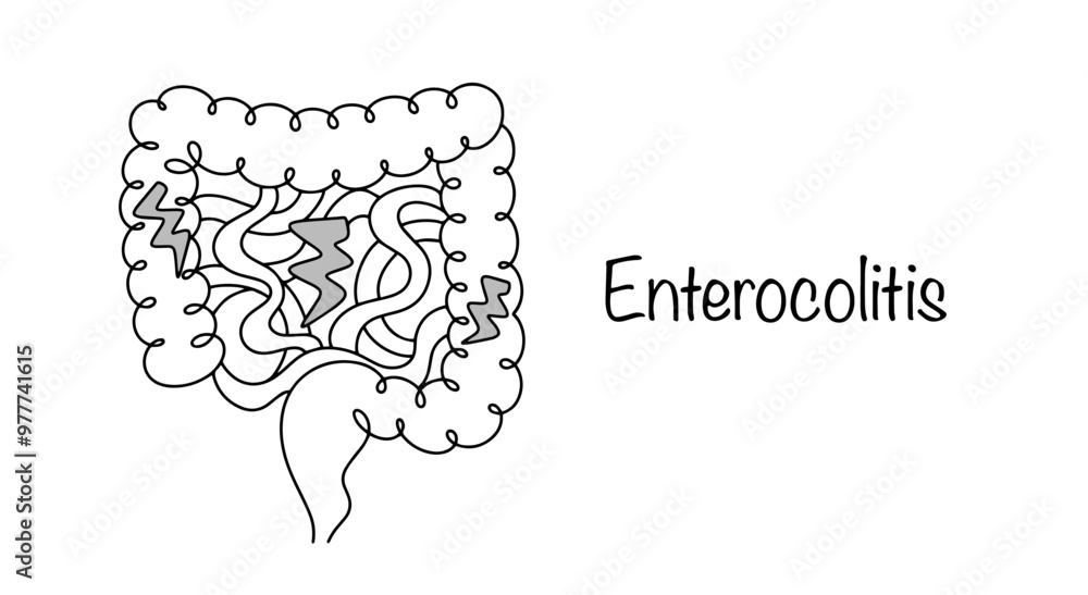 Enterocolitis vector de Stock | Adobe Stock