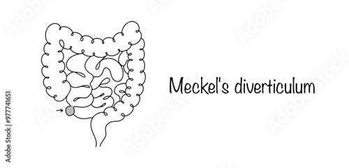 Meckel's diverticulum