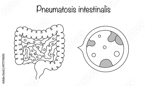Pneumatosis intestinalis