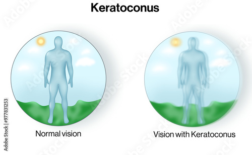 Visual Differences in Normal and Keratoconus Eye Conditions: A Detailed Science Vector Illustration for Understanding Corneal Irregularities and Their Effects on Vision