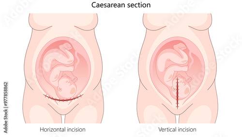 Tableau sur toile caesarean section with horizontal and vertical incisions for delivering a baby through surgical methods hand drawn schematic raster illustration