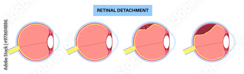 Retinal detachment eye disease