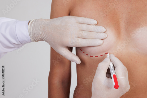 Foto plastic surgeon drawing lines on woman's breast before mammoplasty surgery, brea